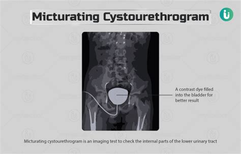 mcu full form medical|Micturating Cystourethrogram (X.